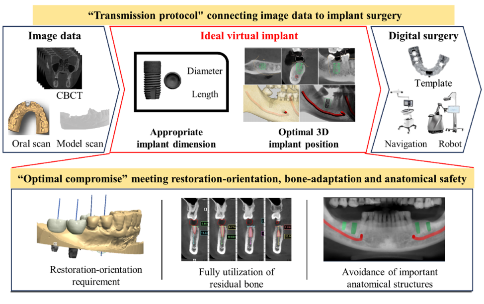 Dental implant placement teaser